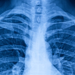 Lung scan - courtesy of iStock/kool99